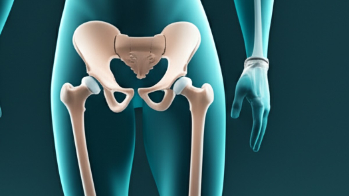 Türkiye'de Kalça Protezi Ameliyatı: Güvenlik ve Maliyet Açısından Kapsamlı Bir Bakış